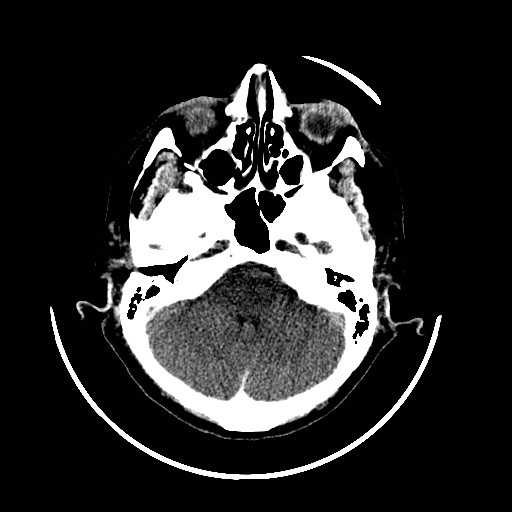 Cerebral edema (evolution in time) (Radiopaedia 19418-19439 non-contrast 23).jpg