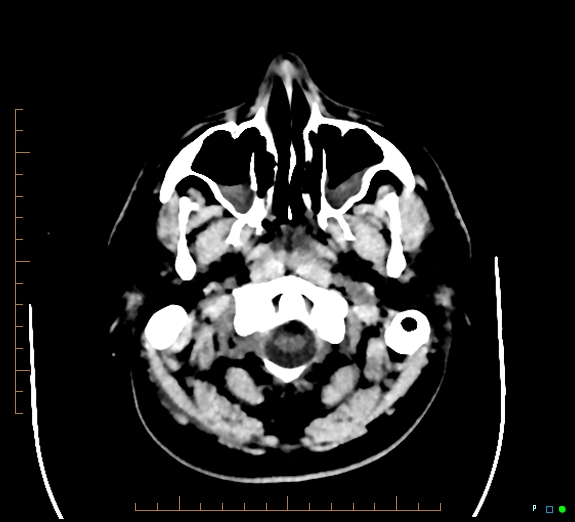 Cerebral fat embolism (Radiopaedia 85521-101220 Axial non-contrast 10).jpg