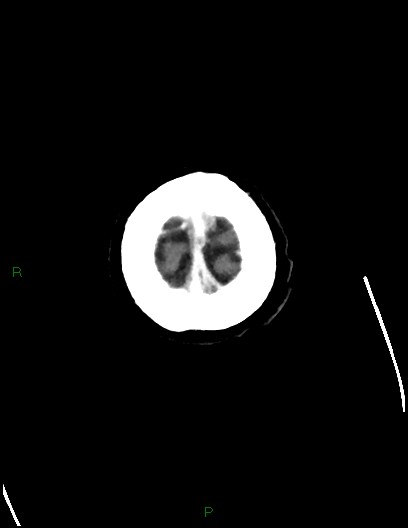 Cerebral metastases - ependymal and parenchymal (Radiopaedia 79877-93131 Axial C+ delayed 83).jpg