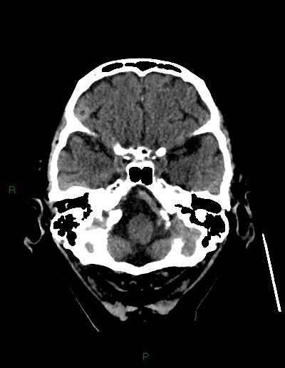 Cerebral metastases - ependymal and parenchymal (Radiopaedia 79877-93131 Axial non-contrast 11).jpg