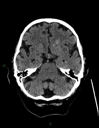 File:Cerebral metastases - ependymal and parenchymal (Radiopaedia 79877-93131 Axial non-contrast 20).jpg