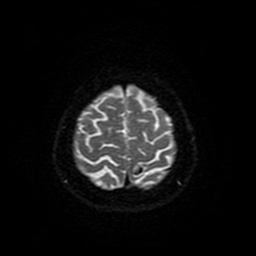 File:Cerebral metastases - melanoma (Radiopaedia 80972-94522 Axial DWI 90).jpg