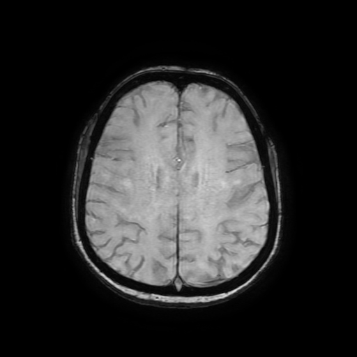 Cerebral metastases - melanoma (Radiopaedia 80972-94522 Axial SWI 68).jpg