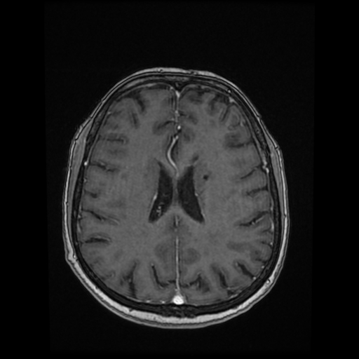 Cerebral metastases - melanoma (Radiopaedia 80972-94522 Axial T1 C+ 63).jpg