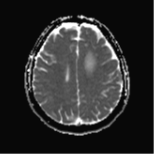 File:Cerebral metastases mimicking abscesses (Radiopaedia 45841-50131 Axial ADC 20).png