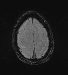 Cerebral metastasis - melanoma (Radiopaedia 54718-60954 Axial SWI 49).png