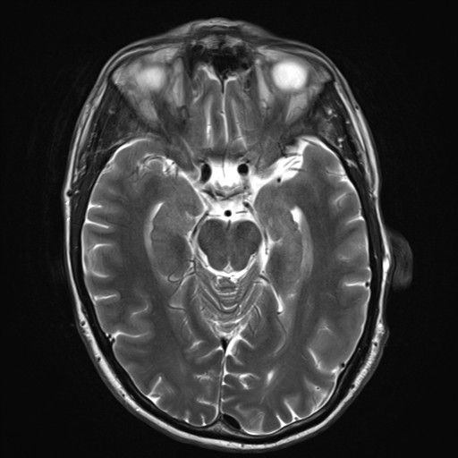 File:Cerebral metastasis - melanoma (Radiopaedia 54718-60954 Axial T2 12).png