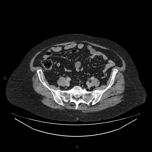 File:Cerebral metastasis from renal cell carcinoma (Radiopaedia 82306-96378 A 137).jpg