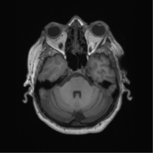 Cerebral metastasis to basal ganglia (Radiopaedia 81568-95413 Axial T1 18).png