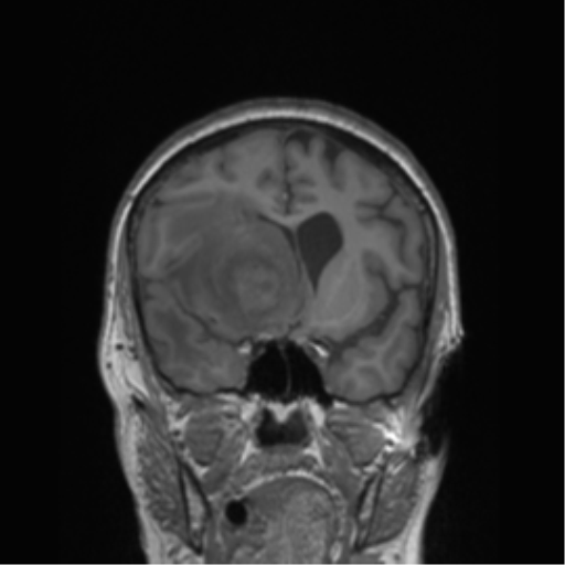 Cerebral metastasis to basal ganglia (Radiopaedia 81568-95413 Coronal T1 38).png