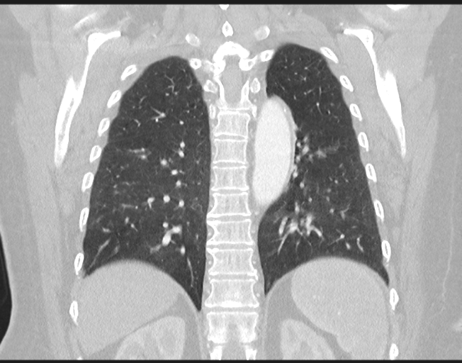 File:Cerebral metastasis to basal ganglia (Radiopaedia 81568-95414 Coronal lung window 62).png