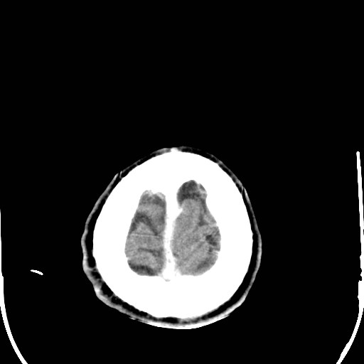 File:Cerebral toxoplasmosis (Radiopaedia 43956-47460 Axial C+ delayed 42).jpg