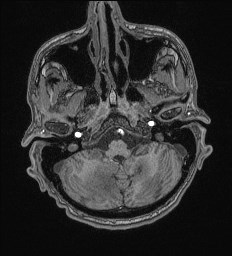 Cerebral toxoplasmosis (Radiopaedia 43956-47461 Axial T1 12).jpg
