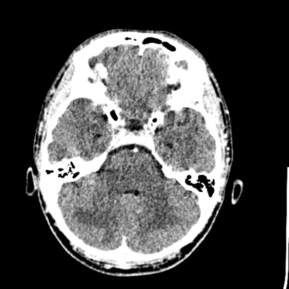 Cerebral toxoplasmosis (Radiopaedia 53993-60131 Axial C+ delayed 22).jpg