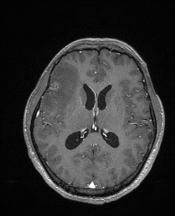 Cerebral toxoplasmosis (Radiopaedia 85779-101597 Axial T1 C+ 92).jpg