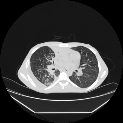 File:Cerebral tuberculoma (Radiopaedia 80829-94318 Axial lung window 86).jpg