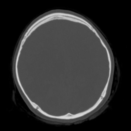 Cerebral tuberculosis with dural sinus invasion (Radiopaedia 60353-68018 Axial bone window 37).jpg