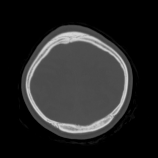 Cerebral tuberculosis with dural sinus invasion (Radiopaedia 60353-68018 Axial bone window 52).jpg