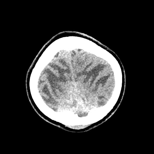 Cerebral tuberculosis with dural sinus invasion (Radiopaedia 60353-68018 Axial non-contrast 56).jpg