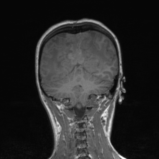 Cerebral tuberculosis with dural sinus invasion (Radiopaedia 60353-68090 Coronal T1 136).jpg