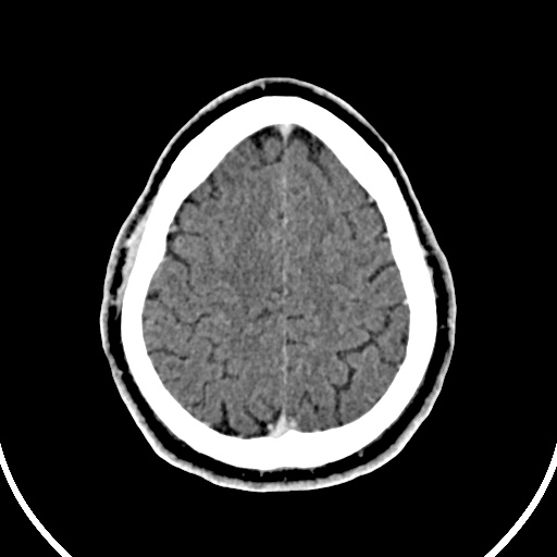 File:Cerebral venous angioma (Radiopaedia 69959-79977 B 86).jpg