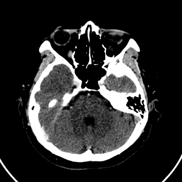 File:Cerebral venous hemorrhagic infarct from venous sinus thrombosis (Radiopaedia 55433-61883 Axial C+ delayed 109).jpg