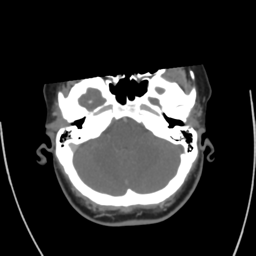 File:Cerebral venous infarct related to dural venous sinus thromboses (Radiopaedia 35292-36804 Axial C+ delayed 12).png