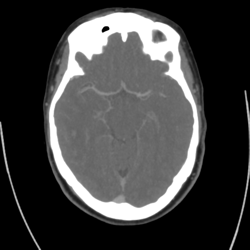 Cerebral venous infarct related to dural venous sinus thromboses (Radiopaedia 35292-36804 Axial C+ delayed 21).png