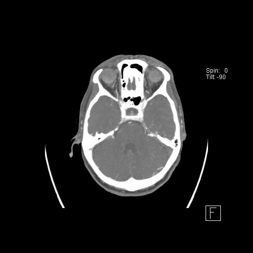 Cerebral venous infarction with hemorrhage (Radiopaedia 65343-74396 A 33).jpg