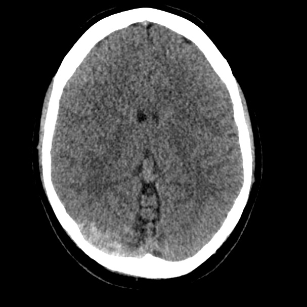 Cerebral venous sinus thrombosis (Radiopaedia 59224-66551 Axial non-contrast 17).jpg