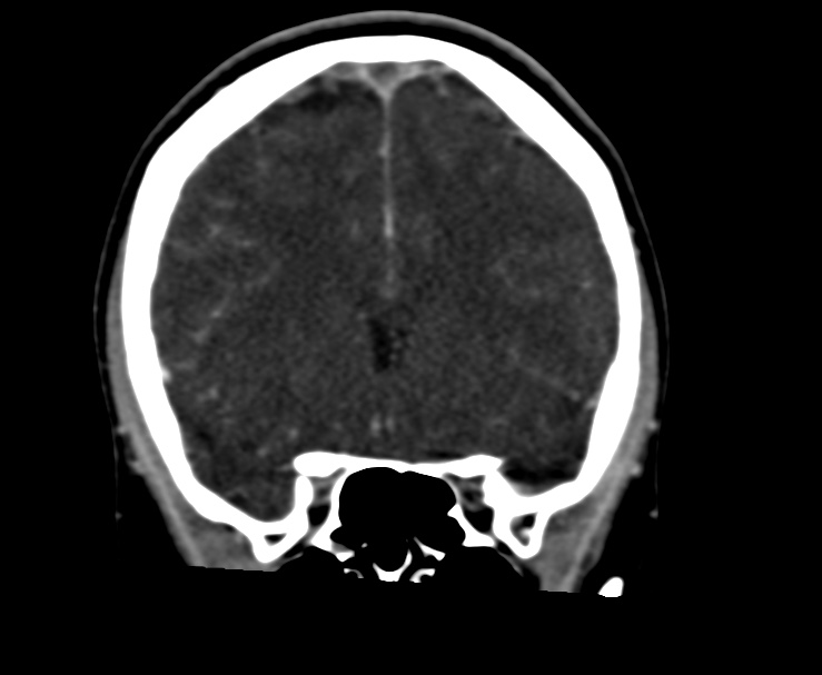 Cerebral venous sinus thrombosis (Radiopaedia 59224-66646 Coronal C+ delayed 25).jpg