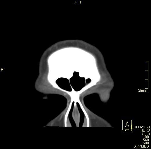 Cerebral venous sinus thrombosis (Radiopaedia 91329-108965 Coronal venogram 7).jpg