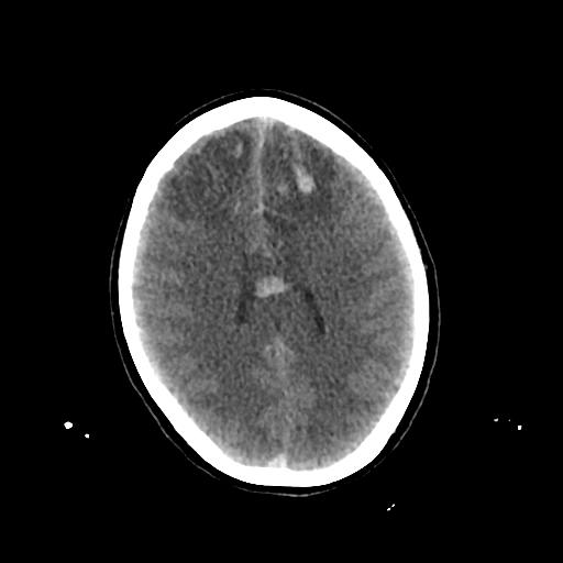Cerebral venous throbmosis - hemorrhagic venous infarction (Radiopaedia 87318-103613 Axial non-contrast 109).jpg