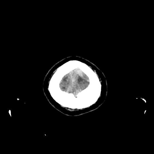 File:Cerebral venous throbmosis - hemorrhagic venous infarction (Radiopaedia 87318-103613 Axial non-contrast 172).jpg