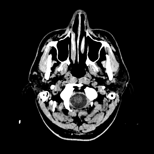 File:Cerebral venous thrombosis (CVT) (Radiopaedia 77524-89685 Axial non-contrast 1).jpg