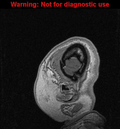 Cerebral venous thrombosis (Radiopaedia 37224-39208 Sagittal T1 C+ 145).jpg