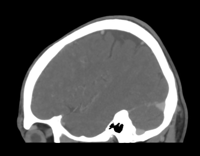 Cerebral venous thrombosis (Radiopaedia 38392-40467 D 13).png