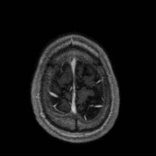 Cerebral venous thrombosis (Radiopaedia 38392-40469 Axial T1 C+ 71).png