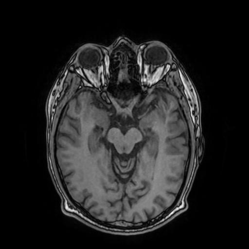 Cerebral venous thrombosis with secondary intracranial hypertension (Radiopaedia 89842-106957 Axial T1 81).jpg
