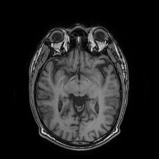 File:Cerebral venous thrombosis with secondary intracranial hypertension (Radiopaedia 89842-106957 Axial T1 86).jpg