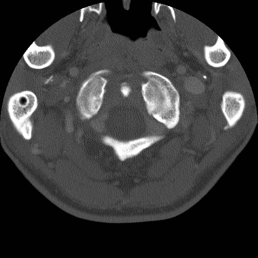 Cervical Pott disease (Radiopaedia 20374-20286 Axial bone window 16).jpg