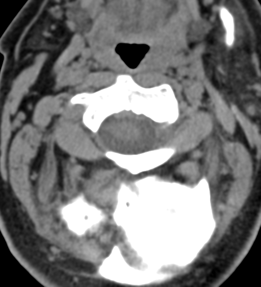 Cervical canal stenosis due to ossification of the posterior longitudinal ligament (Radiopaedia 47260-51823 Axial non-contrast 17).png