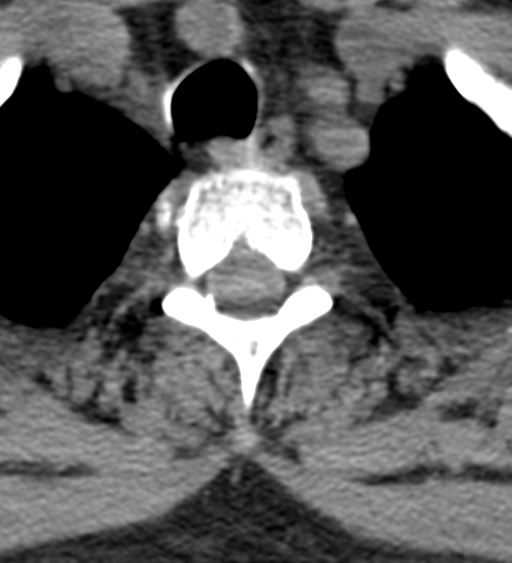 Cervical canal stenosis due to ossification of the posterior longitudinal ligament (Radiopaedia 47260-51823 Axial non-contrast 61).png