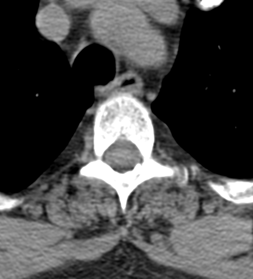 File:Cervical canal stenosis due to ossification of the posterior longitudinal ligament (Radiopaedia 47260-51823 Axial non-contrast 68).png