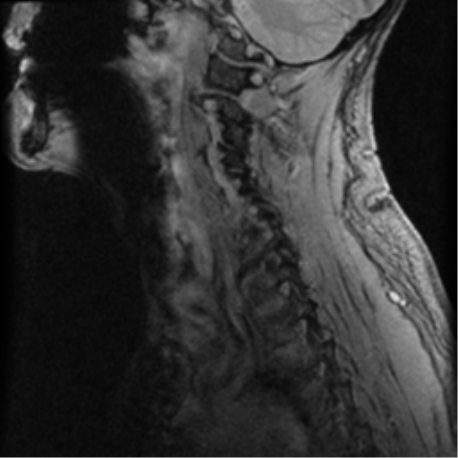 File:Cervical canal stenosis with cord compression (Radiopaedia 34114-35374 D 8).png