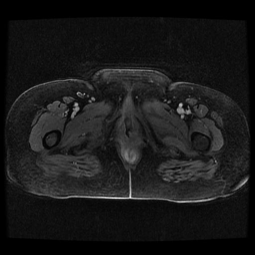 File:Cervical carcinoma (Radiopaedia 70924-81132 Axial T1 C+ fat sat 194).jpg