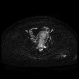 Cervical carcinoma (Radiopaedia 85405-101028 Axial DWI 50).jpg