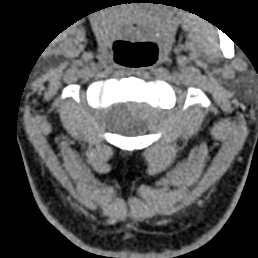 Cervical spinal neurofibroma in a patient with NF1 (Radiopaedia 58344-65464 Axial non-contrast 18).jpg