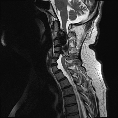 File:Cervical spinal neurofibroma in a patient with NF1 (Radiopaedia 58344-65465 Sagittal T2 5).jpg