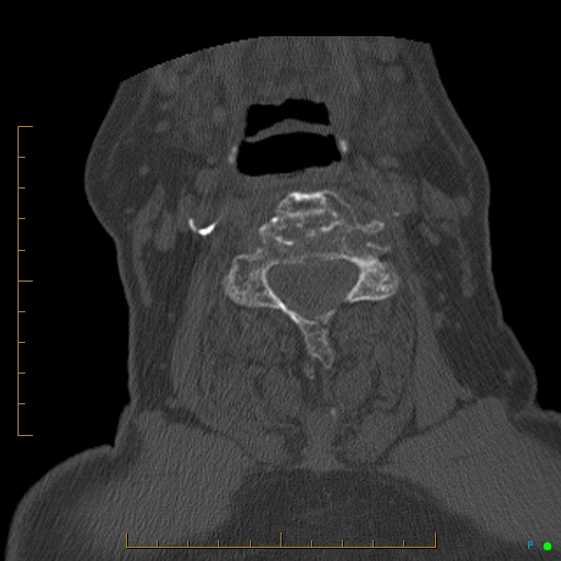 Cervical spine fracture - ankylosing spondylitis (Radiopaedia 76835-88706 Axial bone window 105).jpg